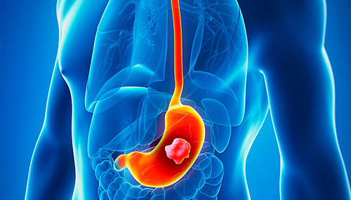 Gastric Stomach Cancer Hospital Mumbai