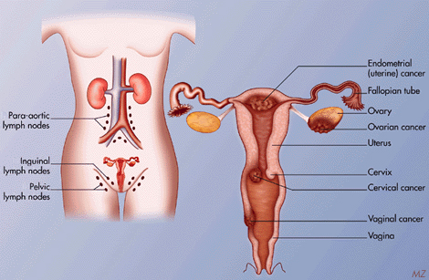 Gynaec Cancer Hospital Mumbai